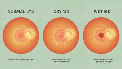 comparison of a normal eye, one with dry macular degeneration, and one with wet macular degeneration